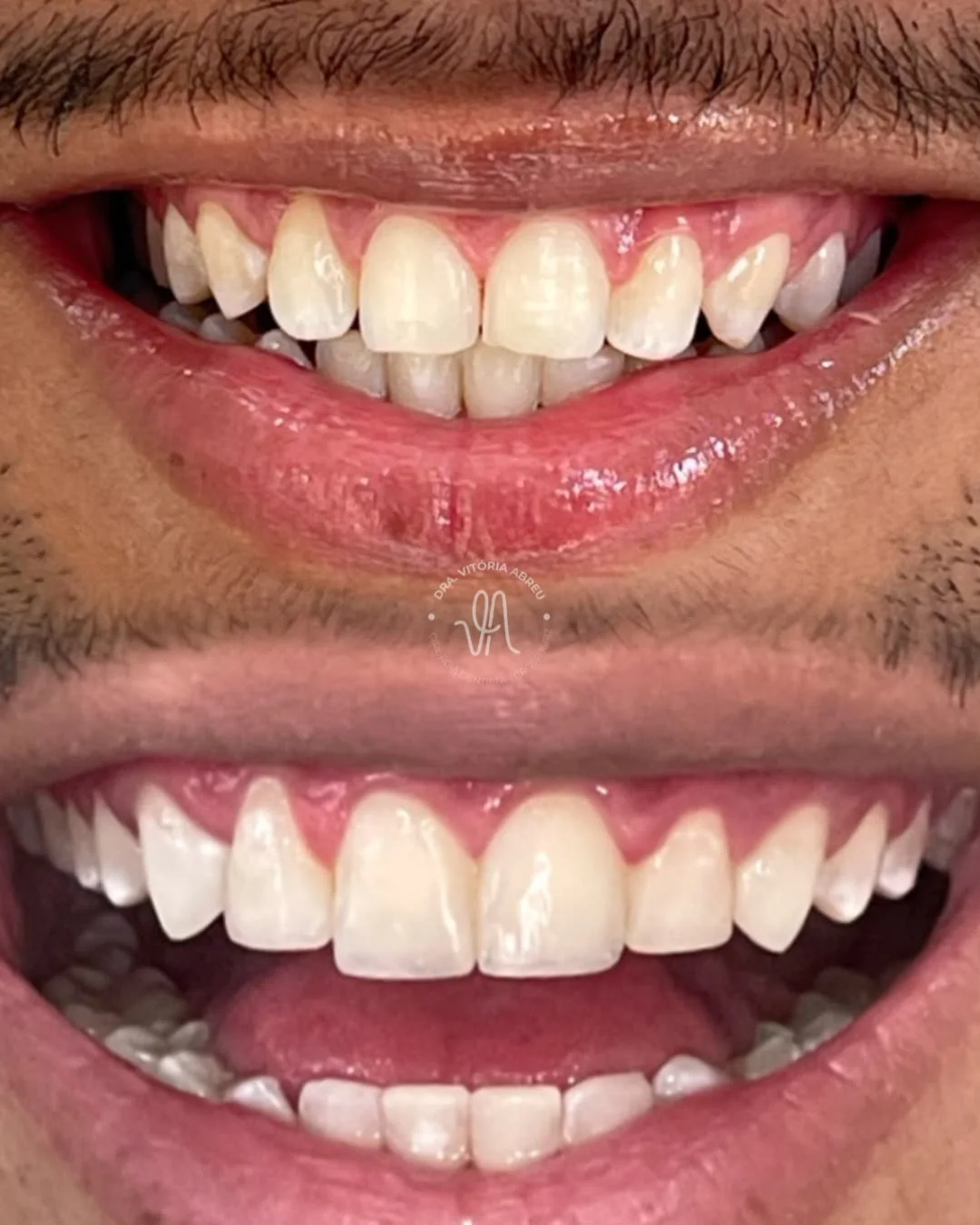 Comparativo odontológico autorizado de sorriso antes e depois