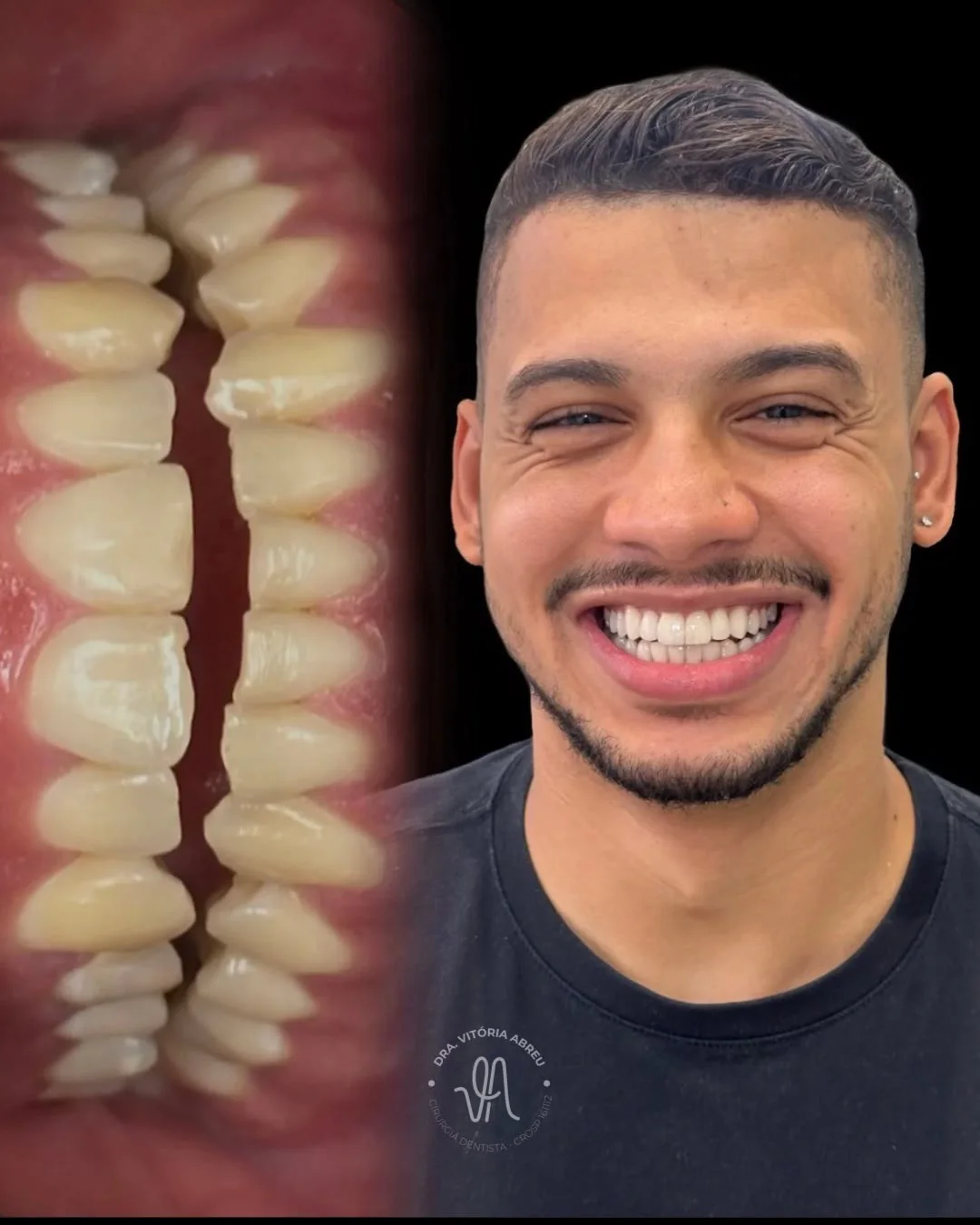 Caso odontológico autorizado com detalhe do sorriso e retrato do paciente