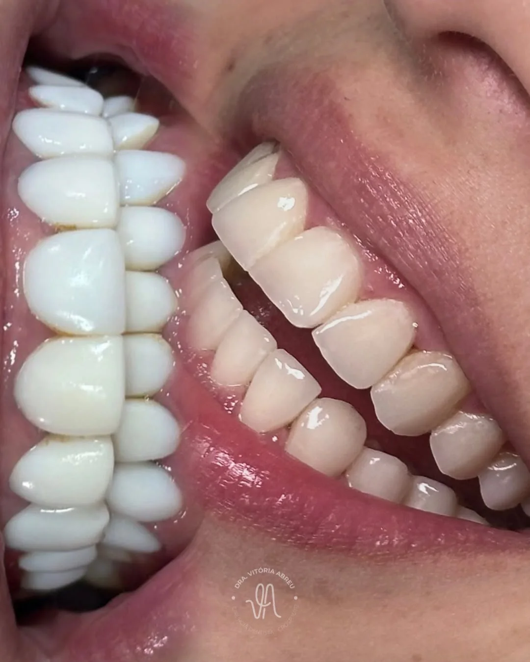 Comparativo intraoral lateral autorizado de resultado odontológico