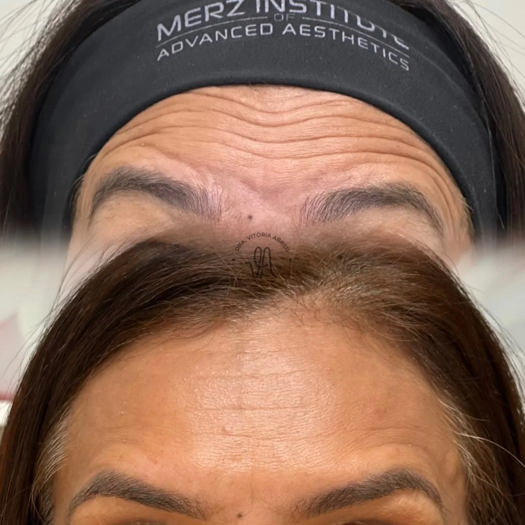 Comparativo autorizado da região frontal antes e depois