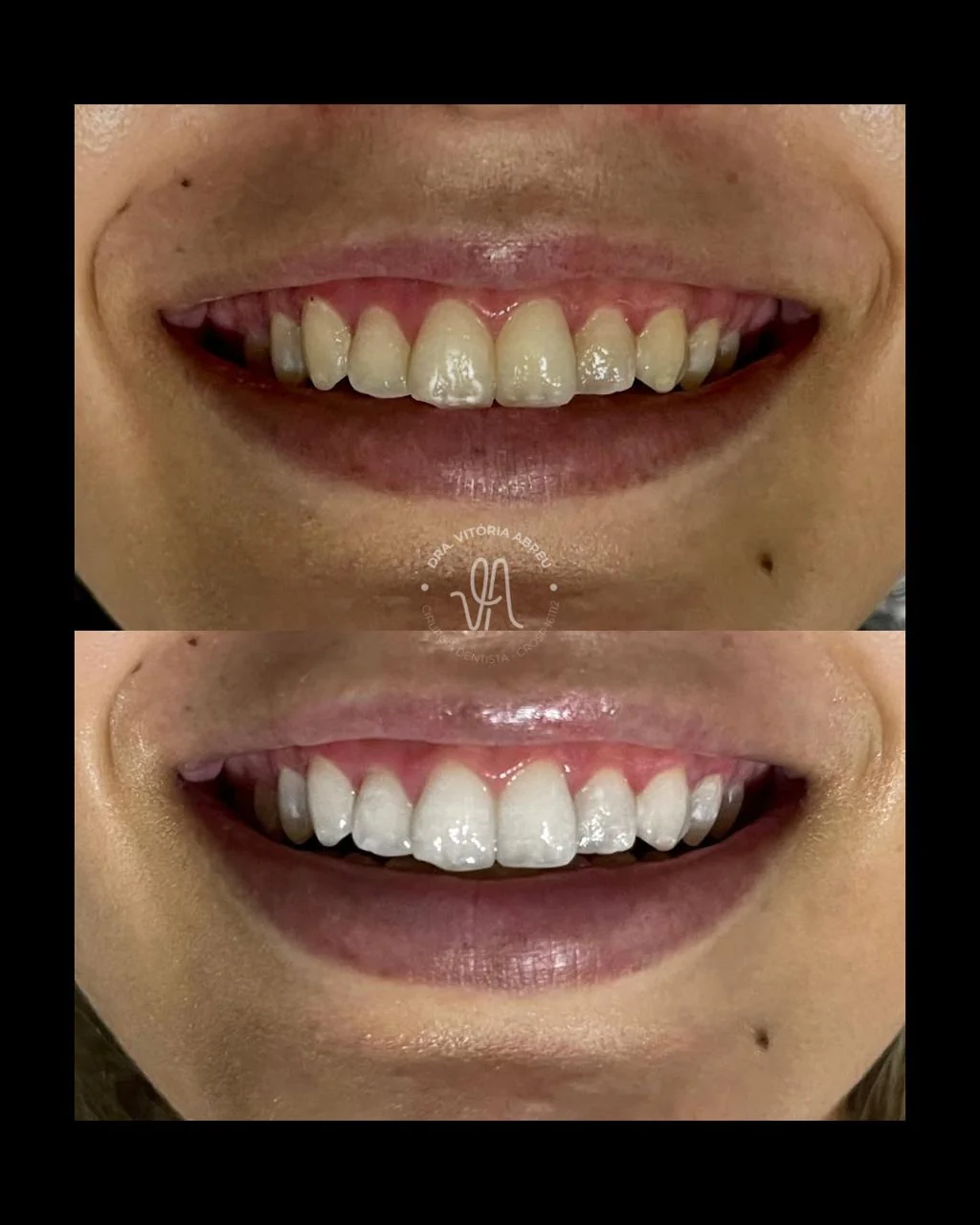 Comparativo clínico autorizado de sorriso antes e depois do tratamento